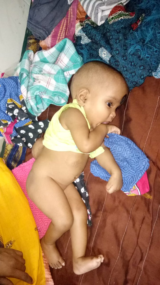 balangir_cdmo's tweet photo. Alia Patel having Neural Tube Defect, underwent surgery  successfully  at SCB Cuttack. https://t.co/x4iwlaEVCH