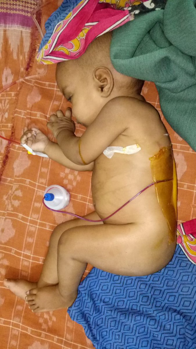 balangir_cdmo's tweet photo. Alia Patel having Neural Tube Defect, underwent surgery  successfully  at SCB Cuttack. https://t.co/x4iwlaEVCH