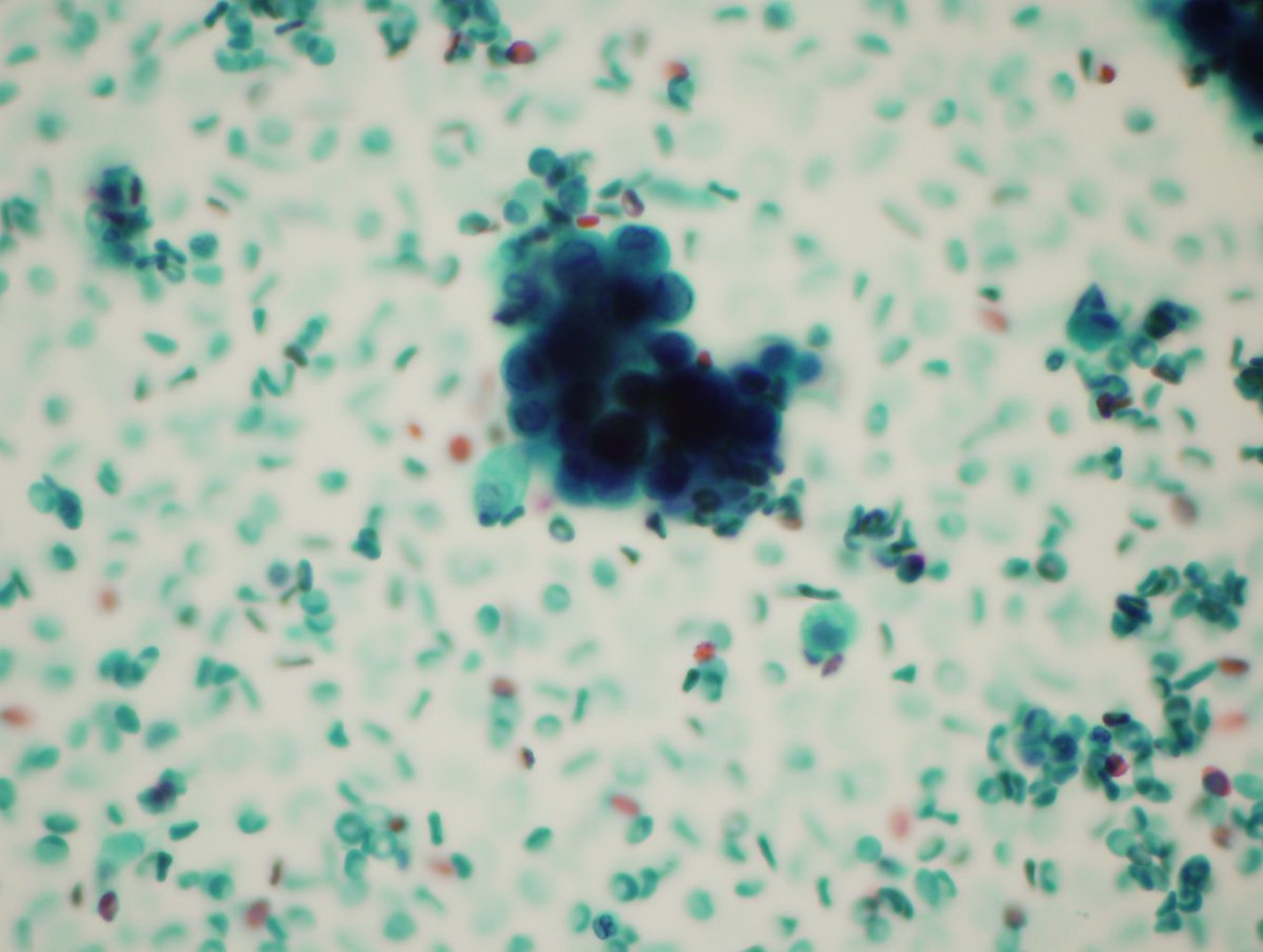 Vanda Torous Md On Twitter Bal Herpes Simplex Virus Multinucleation Nuc Molding Chromatin Margination And Large Nuclear Cowdry A Inclusions Can Cause Pharyngitis Laryngotracheoitis Or Pneumonia Esp In Immunocompromised Or Neonates Hsv 1