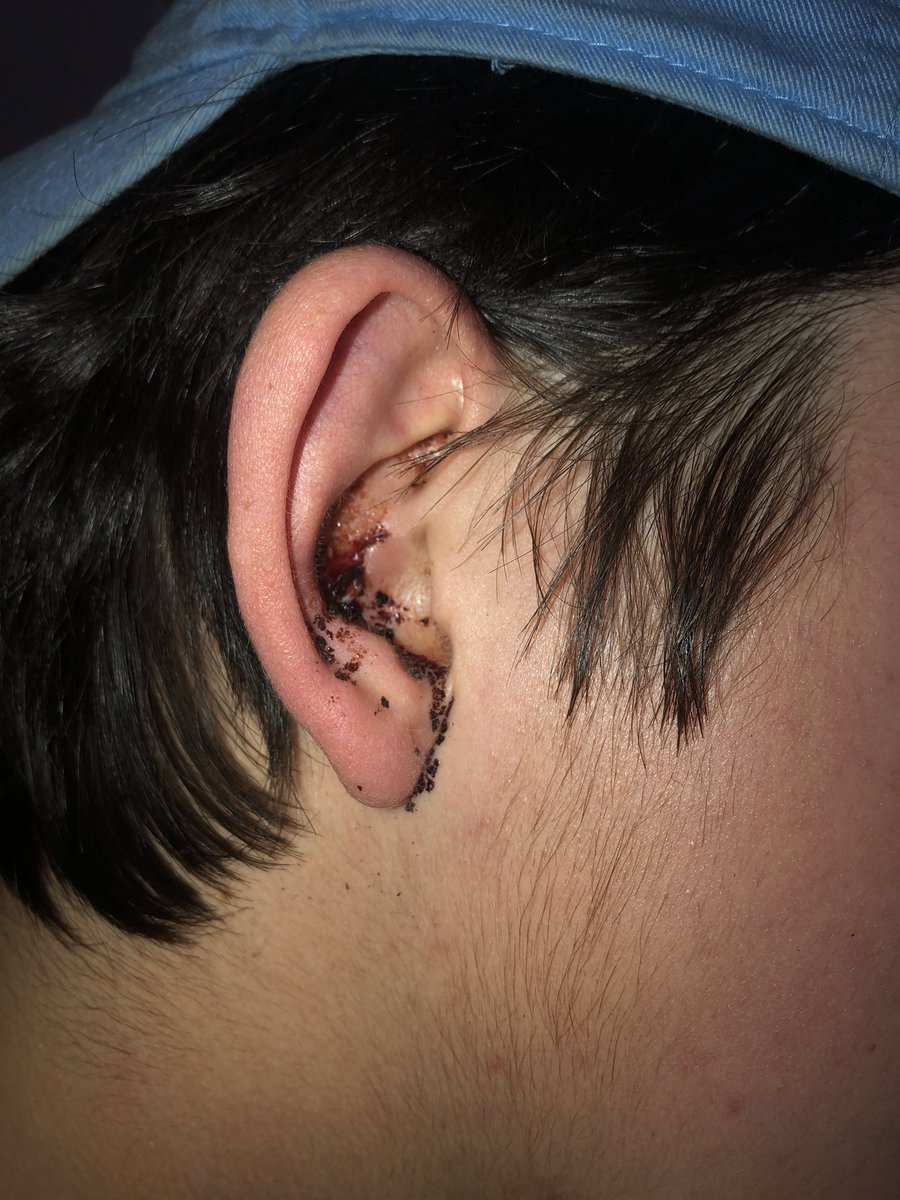 JackSiller30's tweet photo. Metal rods and my head don’t mix🥴🤕 https://t.co/mKotQsddiU