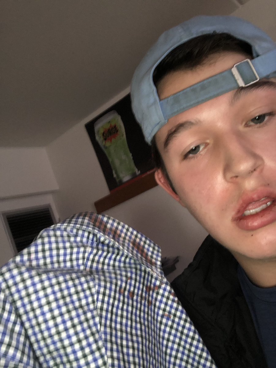 JackSiller30's tweet photo. Metal rods and my head don’t mix🥴🤕 https://t.co/mKotQsddiU