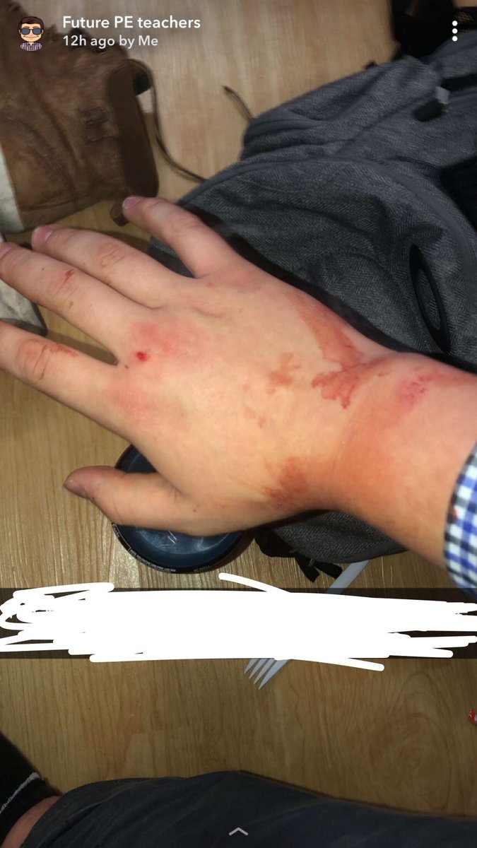 JackSiller30's tweet photo. Metal rods and my head don’t mix🥴🤕 https://t.co/mKotQsddiU