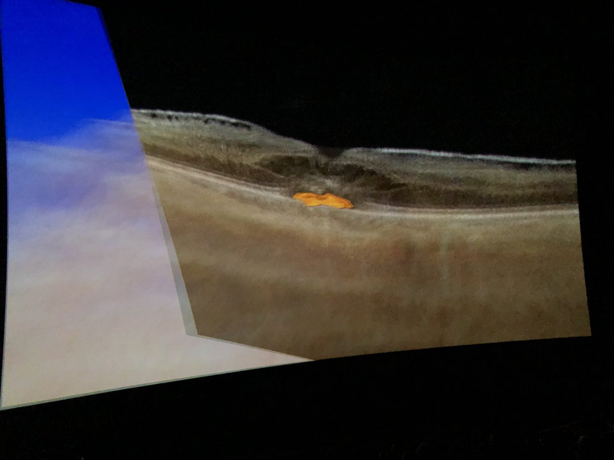 pearsekeane's tweet photo. First time to see #OCT #retina on an IMAX!! Amazing #retinopsy conference organised by @MalocaPeter https://t.co/eLDjnxZx1m