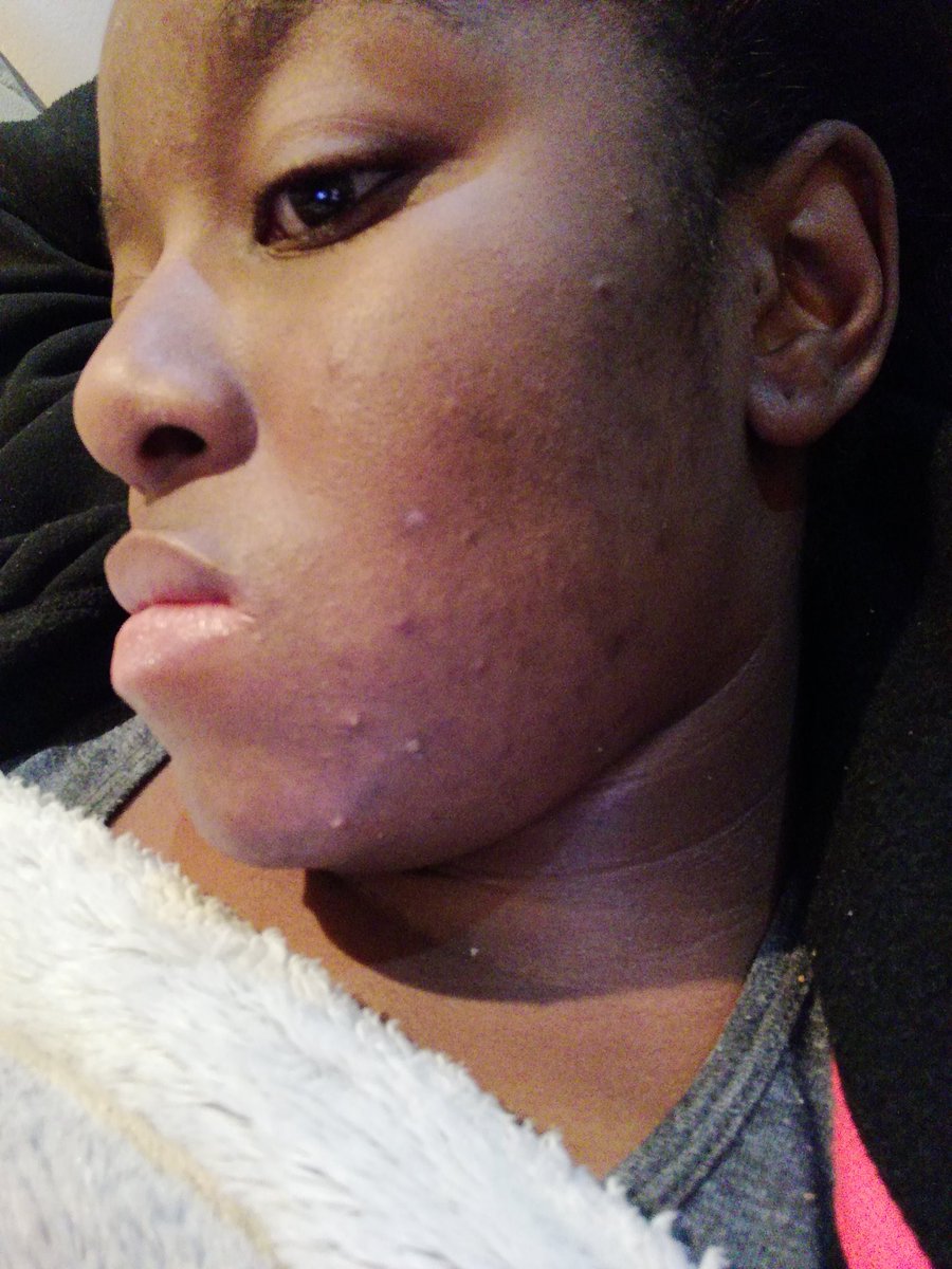 Purchase roaccutane