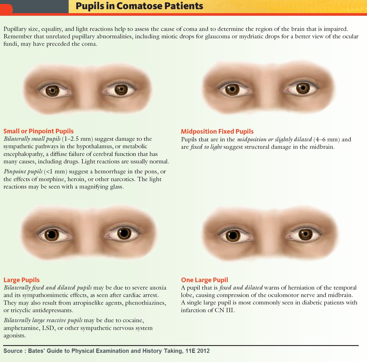 dilated-pupils-vs-constricted-pupils