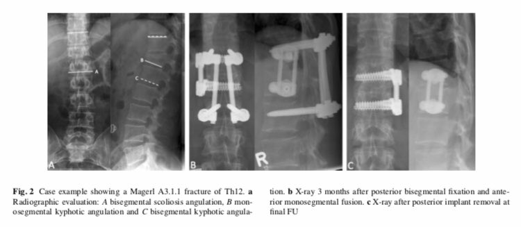 EurSpineJournal's tweet image. #Posterior or #posterior_anterior stabilization of thoracolumbar incomplete cranial #burst_fractures in neurological intact patients?
goo.gl/DeuKFK