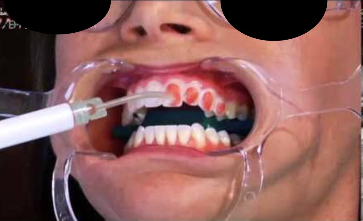 Dr.Bandar on Twitter "Effect of hydrogen peroxide on color and whiteness of resin based