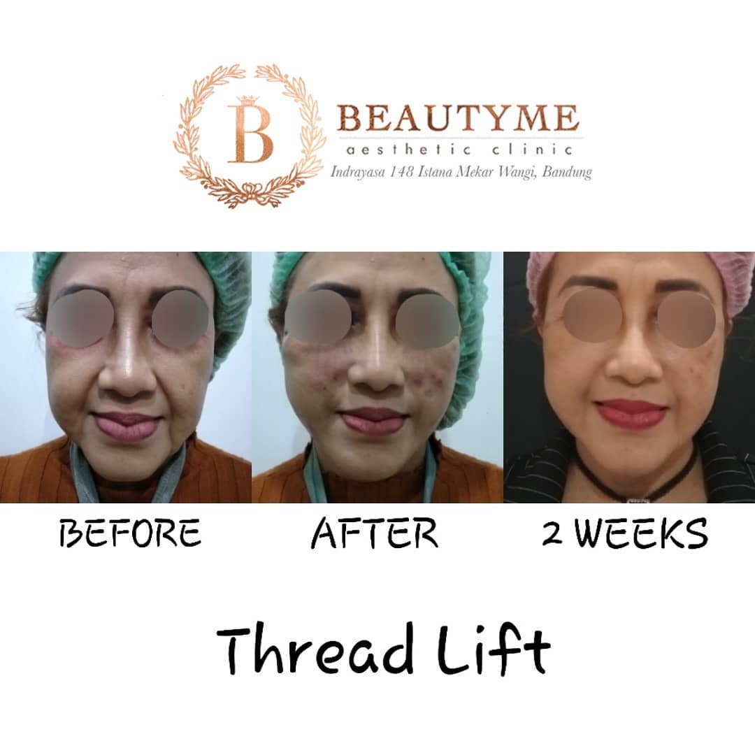 Beautyme Aesthetic berada di Kota Bandung.
9 menit Thread lift atau tarik benang dapat memperbaiki dan mengencangkan kembali kulit wajah yang telah kendur. Stimulasi kolagennya dapat membuat wajah kembali muda dan tampak sehat. 
instagram.com/p/BrCespPA9u9/ 
#tearthrough #fillerbotox