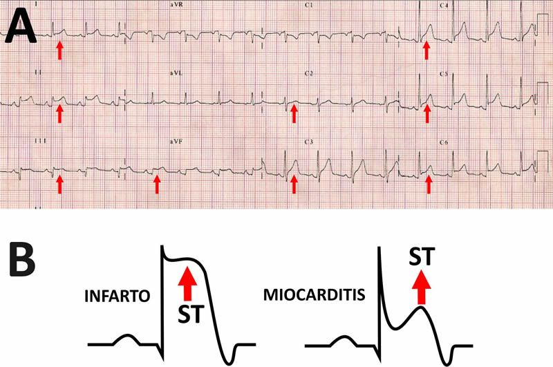 ImagenCardiaca's tweet photo. ¿Cómo es el ECG en las pericarditis? https://t.co/JOX3a4R0Z7
Repasando las preguntas de nuestra Biblioteca de preguntas básicas de imagen cardíaca https://t.co/5nDIU3WxNT