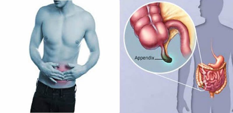 Где аппендикс у человека как болит. Организм человека аппендикс.