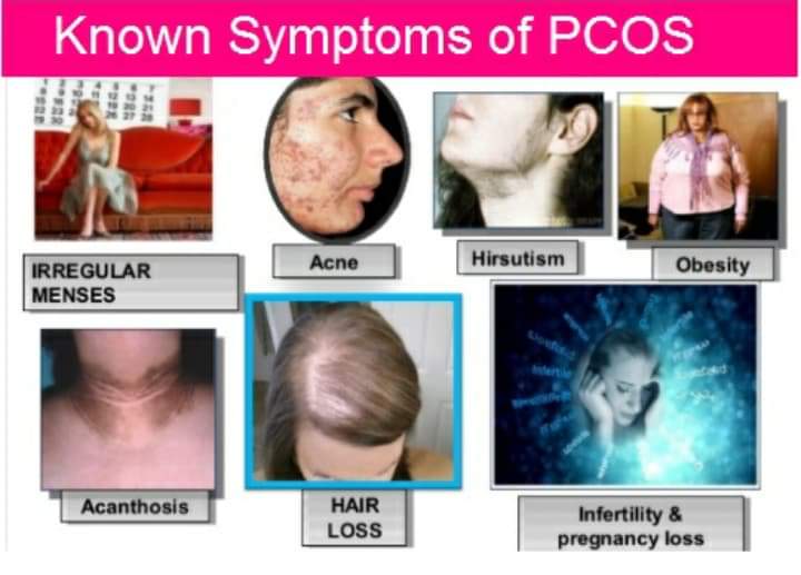 BunnyLawrence7's tweet photo. POlYCYSTIC OVARY SYNDROME!

 Untreated PCOS can lead to serious health problems eg problem with your periods ,difficult to get pregnant unwanted changes the way you look etc

It's a problem where a woman's hormones are out of balance/ hormone disorder. https://t.co/DVpZurG6Tu
