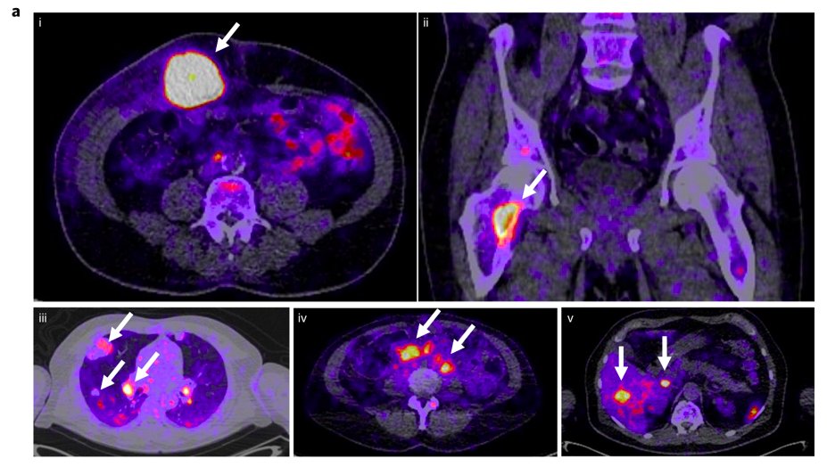 Initial results from a first-in-human study show that PET imaging with PD-L1 antibodies outperforms immunohistochemistry- or RNA-sequencing-based biomarkers for prediction of clinical response to #immunotherapy: go.nature.com/2DNW412