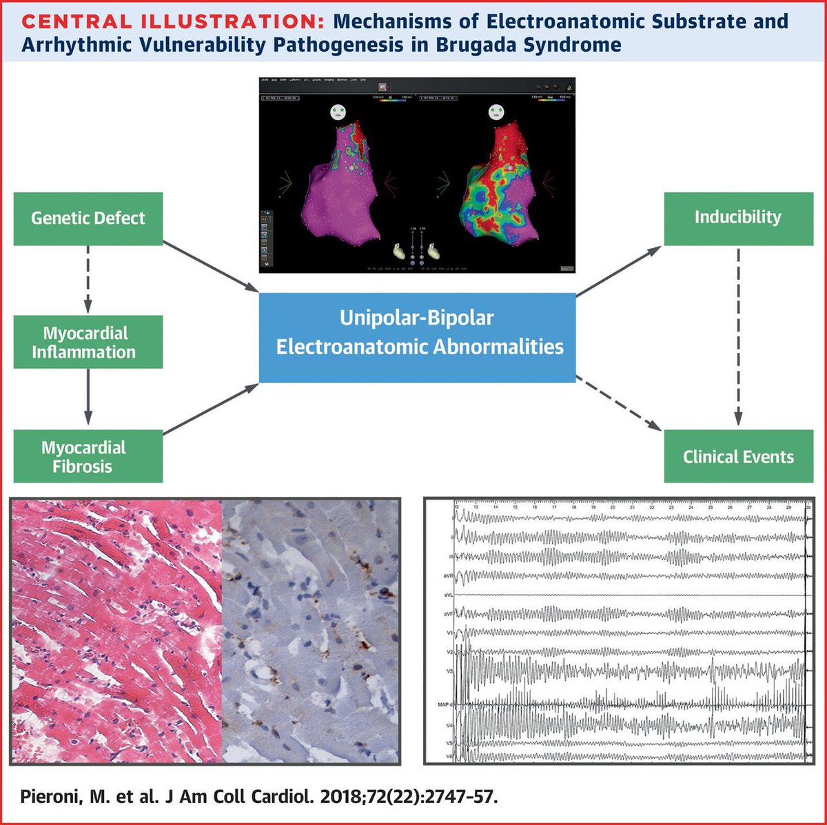Time to redefine the Brugada syndrome as Brugada cardiomyopathy? Congratulations to my colleague and friend <a href="/mauripieroni72/">Maurizio Pieroni</a> for leading this important study, always great to collaborate onlinejacc.org/content/72/22/… <a href="/PennMedNews/">Penn Medicine News</a> <a href="/JACCJournals/">JACC Journals</a>