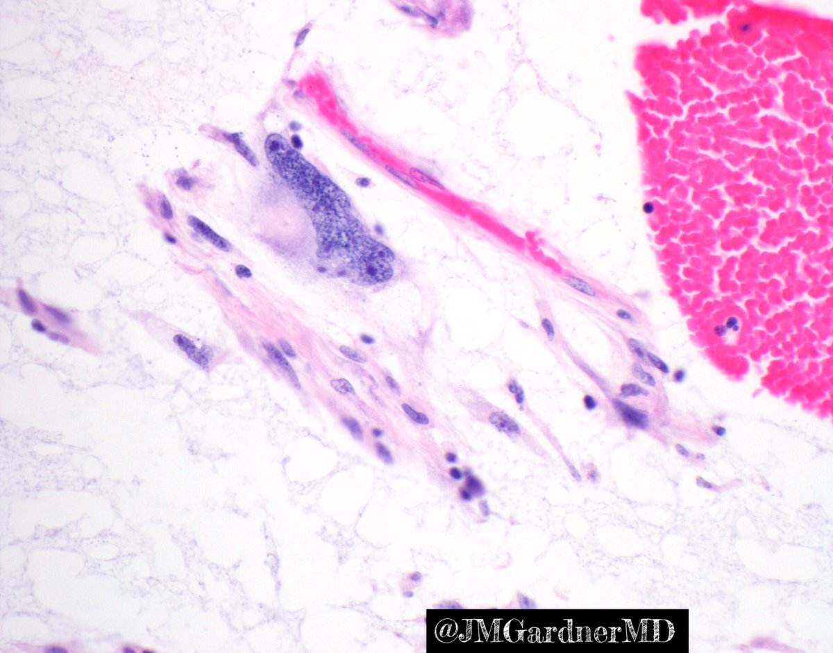 Myxofibrosarcoma. Hypocellular myxoid areas w scattered atypical cells. Long curvilinear vessels. Solid zones resembling undiff. pleomorphic #sarcoma. Extremities of elderly. 50% involve skin/subcutis. My video: buff.ly/2D9iuet #pathology #BSTpath #meded #dermpath