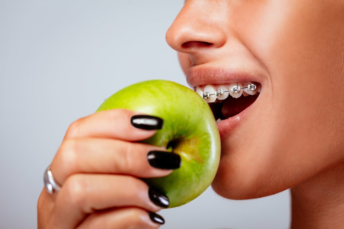 FamilyBracesSC's tweet photo. 🍭🍬Are you craving candy while wearing braces? A good rule of thumb is to skip any sticky, chewy or hard foods. Sticky foods, such as caramels or gummy candy, are likely to get stuck. https://t.co/5S6woHMH8D #ToothyTuesday #DentalTips #BracesCare #BracesLife https://t.co/a1fgSFp8q2
