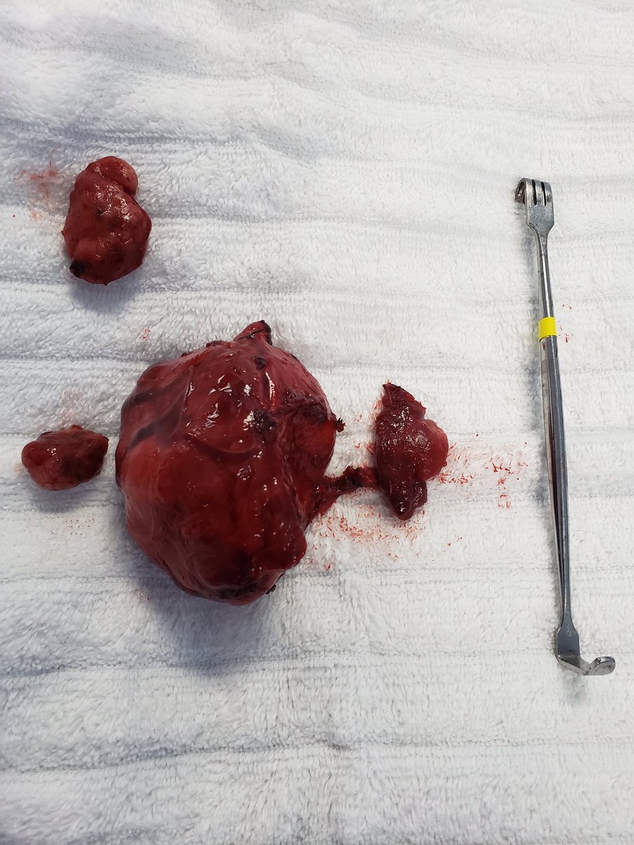 danielrojasonc1's tweet photo. Carcinoma medular de tiroides, conglomerados ganglionares. Estirpe poco frecuente! 😷 https://t.co/VMd5gksKKF