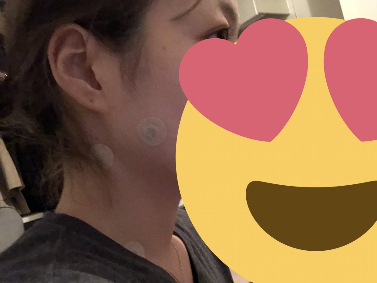 だぶ ピップエレキバン を頬の筋肉のところに貼るとボトックスと同じような効果が得られると聞き昨日やってみたのですが 朝起きた時いつも歯ぎしりのせいで首回りとかだるいのにスッキリしてたし 今日 痩せた 顔小さくなった って言われたよ むしろ