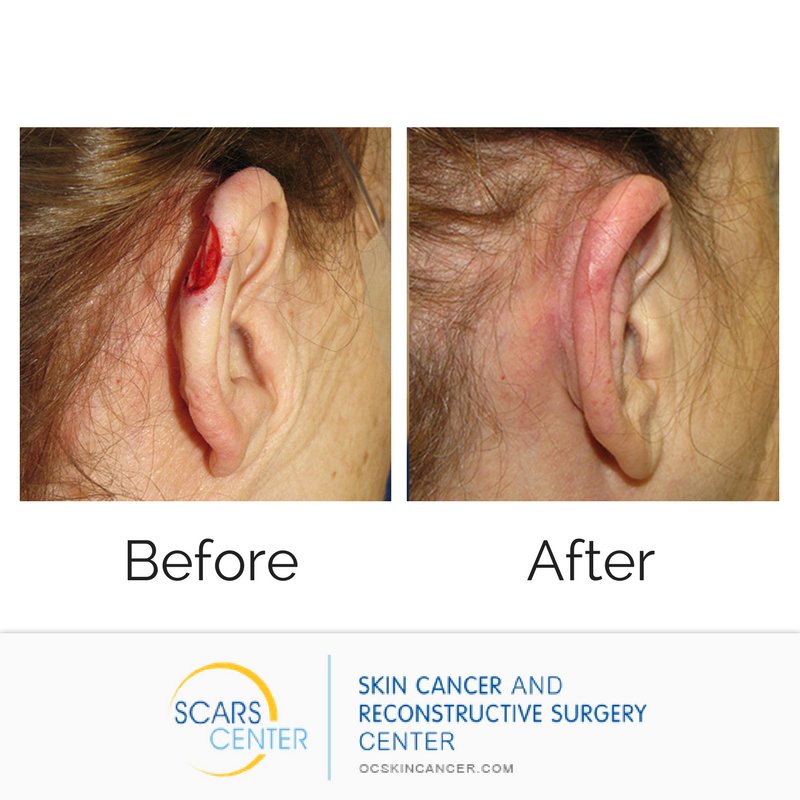SCARSCenter's tweet image. Don't worry, ladies, you can still wear #earrings even after #skincancer treatment on your ears. Just remember your sunscreen when you walk out the door! (949) 719-1800