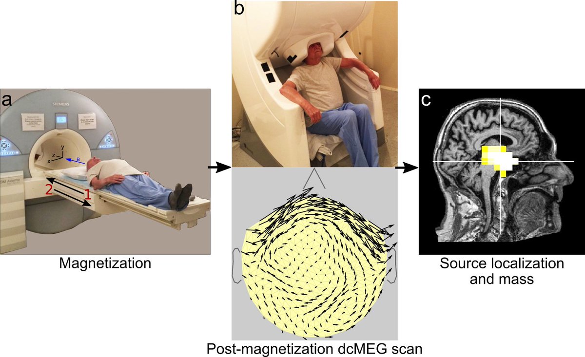 MGH Martinos Center (@mghmartinos) on Twitter photo Using #MEG, Sheraz Khan & David Cohen have shown they can measure the iron-based mineral magnetite in the human brain. Magnetite may play a role in neurodegenerative disorders like #Alzheimers disease. Read more here: bit.ly/2PXUL6F #MGH <a href="/dr_sheraz/">Sheraz Khan</a> Using #MEG, Sheraz Khan & David Cohen have shown they can measure the iron-based mineral magnetite in the human brain. Magnetite may play a role in neurodegenerative disorders like #Alzheimers disease. Read more here: bit.ly/2PXUL6F #MGH <a href="/dr_sheraz/">Sheraz Khan</a>