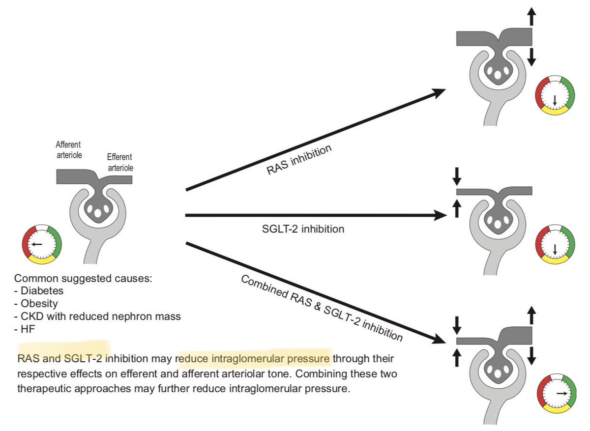 Los GLUCOSURICOS disminuyen la presión INTRAGLOMERULAR complementando el efecto del iECA/ARA2, sin causar HIPERKALEMIA o DAÑO RENAL AGUDO; está combinación tiene GRAN BENEFICIO potencial en nefropatía diabética.

Clinical Kidney Journal, 2018, 1–13 doi: 10.1093/ckj/sfy090