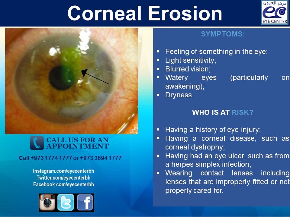 Corneal Abrasion And Corneal Erosion West Coast West Coast