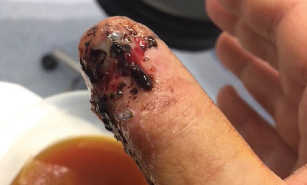 sunbeltrentaluk's tweet photo. Would you want a thumb like this? Didn’t think so.
As part of #SafetyWeek2018 we wanted to highlight to all our 3,600 staff the actions they can take to prevent injury #worksafehomesafe
#togetherweareaplant #safety https://t.co/gwe4gSFos4