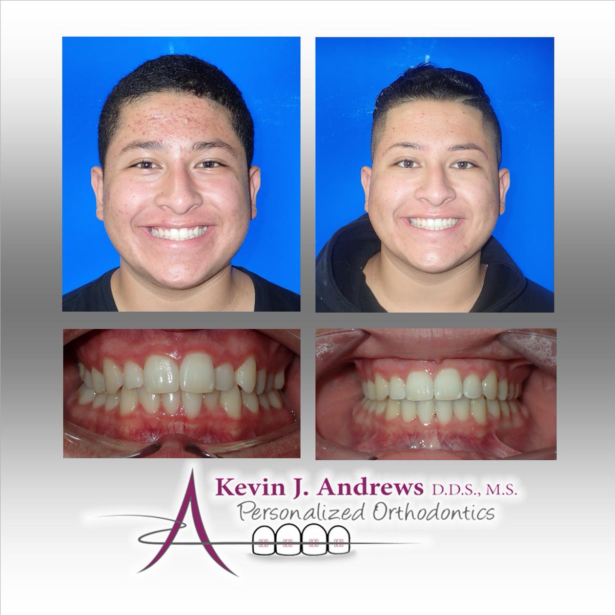 AndrewsBraces's tweet photo. Eric!!!  Congrats bud!  Your smiles is amazing!!! #AndrewsBraces #NewSmile #LoveToSmile #InstaPic #Me #NoFilter #WePutOurHeartIntoYourSmile #Reno https://t.co/CQH2Nx808L