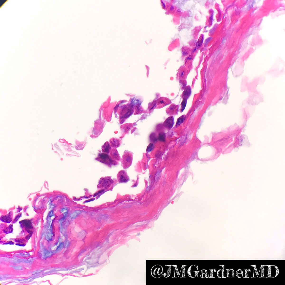 Diagnosis: Staph scalded skin syndrome. SSSS (not SJS/TEN). Detached stratum corneum w free floating acantholytic keratinocytes (key to dx!). If corneum missing look around slide to try to find it. No inflammation or bacteria (toxin mediated). #dermpath #Pathology #dermatology
