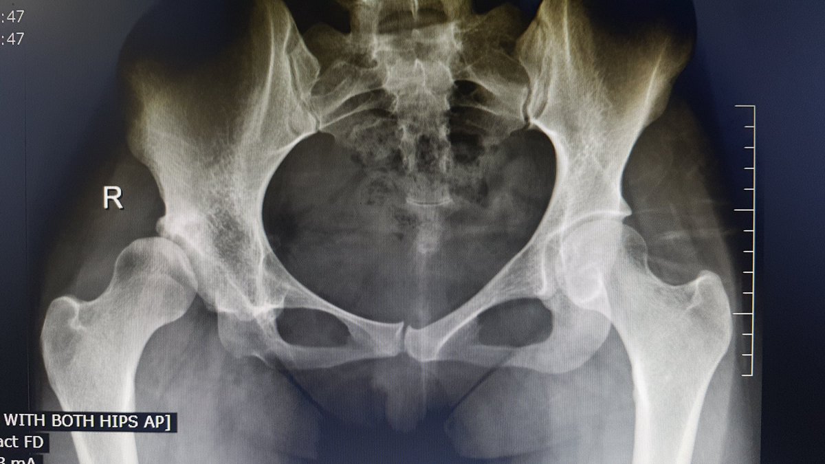 fdoubleu74's tweet photo. Amazing how the body compensates for #disabilities. A #dysplastic hip that has remained asymptomatic for 23 years without being picked up throughout childhood or adolescence. Now causing pain. #WednesdayWisdom #HipDysplasia #EarlyArthritis #THR #Osteotomy https://t.co/obnEiV62zb