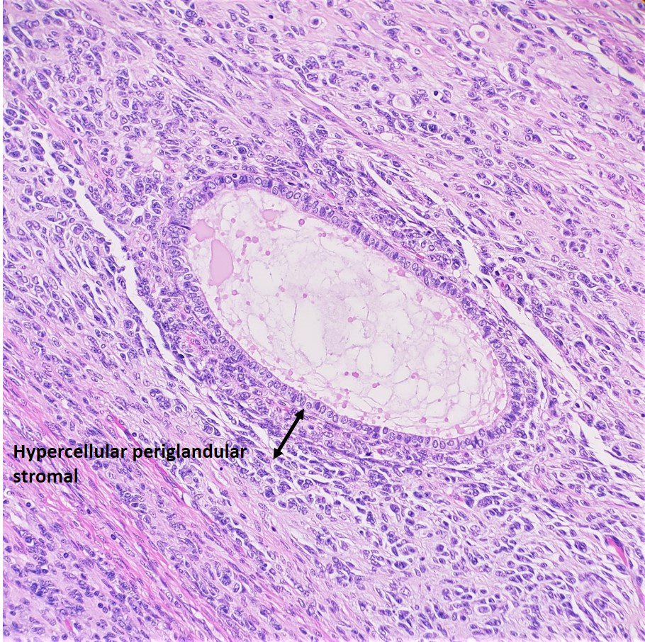 SamankanMD's tweet photo. Uterine Adenosarcoma
📍Benign epithelium
📍Malignant stroma: usually low grade sarcoma
📍Leaflike pattern and/or cyst formation
📍Periglandular cuffing
📍MF >2 /10HPF
📍IHC: CD10
📍Poor prognosis: Myometrial invasion, sarcomatous overgrowth, high grade sarcoma
#GynPath #Surgpath https://t.co/nf9paTuSiC