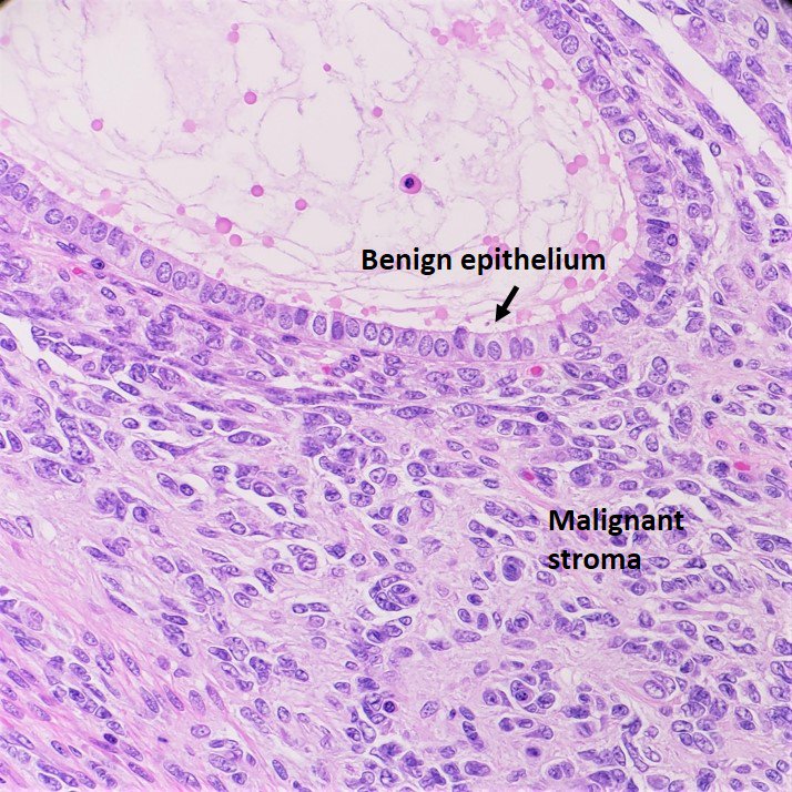 SamankanMD's tweet photo. Uterine Adenosarcoma
📍Benign epithelium
📍Malignant stroma: usually low grade sarcoma
📍Leaflike pattern and/or cyst formation
📍Periglandular cuffing
📍MF >2 /10HPF
📍IHC: CD10
📍Poor prognosis: Myometrial invasion, sarcomatous overgrowth, high grade sarcoma
#GynPath #Surgpath https://t.co/nf9paTuSiC