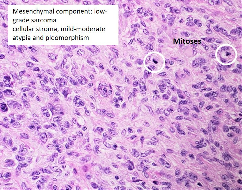 SamankanMD's tweet photo. Uterine Adenosarcoma
📍Benign epithelium
📍Malignant stroma: usually low grade sarcoma
📍Leaflike pattern and/or cyst formation
📍Periglandular cuffing
📍MF >2 /10HPF
📍IHC: CD10
📍Poor prognosis: Myometrial invasion, sarcomatous overgrowth, high grade sarcoma
#GynPath #Surgpath https://t.co/nf9paTuSiC