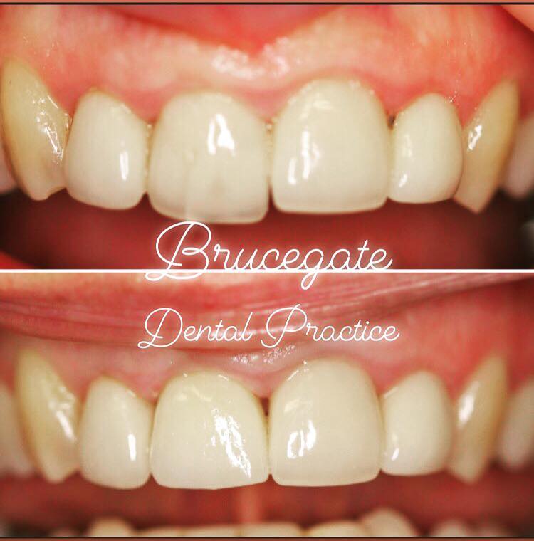 BrucegateDental's tweet image. This patient had put up with a wonky front crown for many years. It was simple to replace with a new straight one, that matched their other teeth.
The patient was over the moon with the result!
#Dentist #CosmeticDentistry #FrontTeeth #BeforeAndAfter #Smile #Happy #Crown