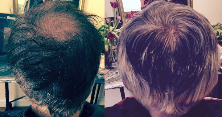BBMedSpa's tweet photo. Survey says... when a man goes #gray he looks distinguished. And when a man goes #bald he looks old. Don't settle for the latter. Call the hair replacement experts at @BBMedSpa  (800)675-7779 https://t.co/oA1HbG6Bh5