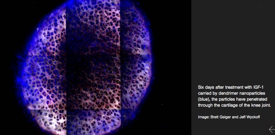 MITdeptofBE's tweet photo. Potential osteoarthritis treatment prevents cartilage breakdown. BE grad student Brett Geiger is lead author of paper which appears in Science Translational Medicine https://t.co/fQ8lTaXjR5 @BrettCGeiger @ScienceTM #HammondLab @MITChemE #GrodzinskyLab #nanotech @BrighamWomens https://t.co/RGT4gOPF21