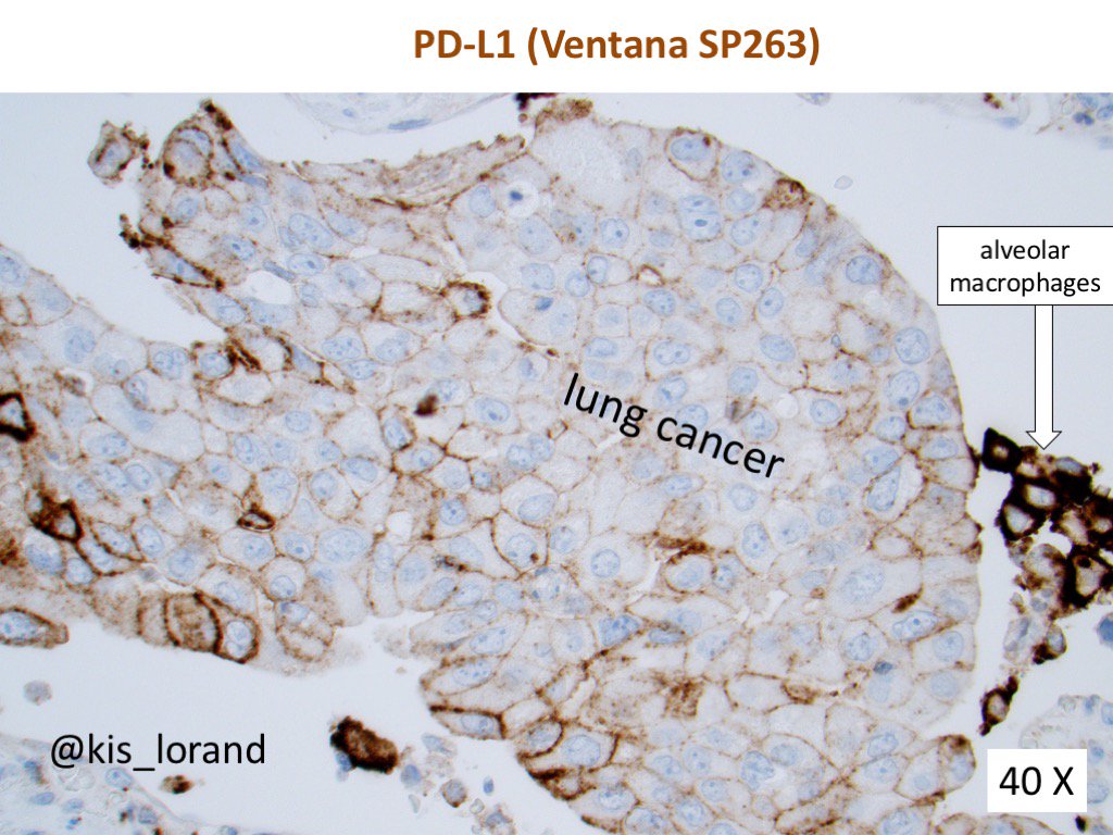 15. In clinical praxis there are only 2 validated predictive biomarkers for these treatments:a). PD-L1 protein expression by IHC in tumor cells or tumor-infiltrating immune cells (useful to a certain degree to predict responses in NSCLC, gastric and gastro-esophageal