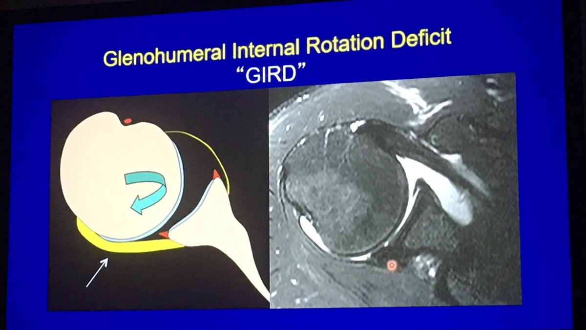 Great summary of physiopathological concepts in shoulder injuries of the throwing athlete by Lynne Steinbach at #RSNA18 . Highlight on posterior superior glenoid impingement and glenoid internal rotation deficit. #shoulder #MSKrad