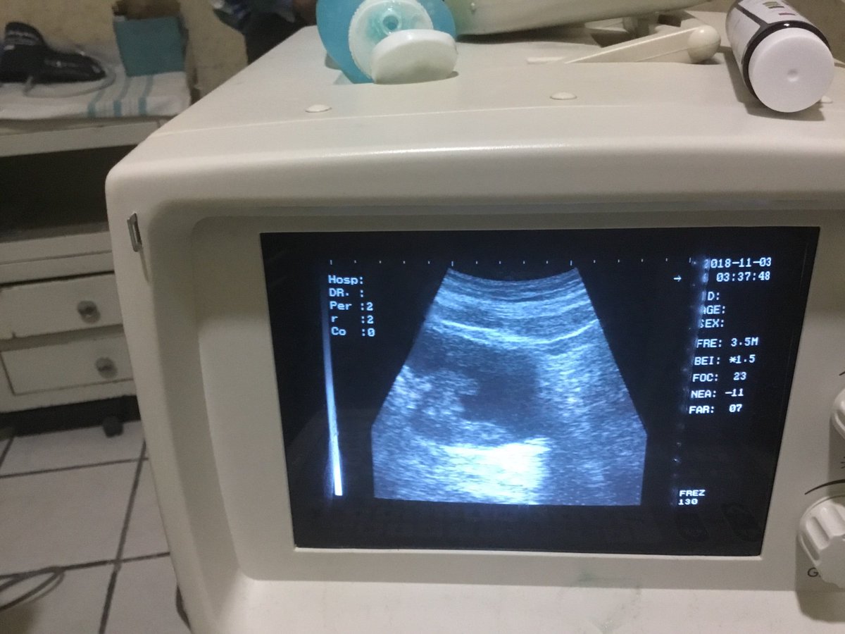 Imagen por ultrasonido de tumor vesical, dejar de fumar es lo mas importante