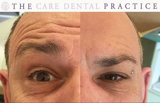 caredentalgroup's tweet image. ✨#ANTI #WRINKLE #TREATMENT #FOR #MEN ✨ . Forehead lines are reduced by Dr Rubina @doctorubina using the product Azzalure ✨Dr Rubina has softened and has resolved the fine lines &amp;amp; creases of this patient's  forehead giving a more youthful and vibrant look to the skin