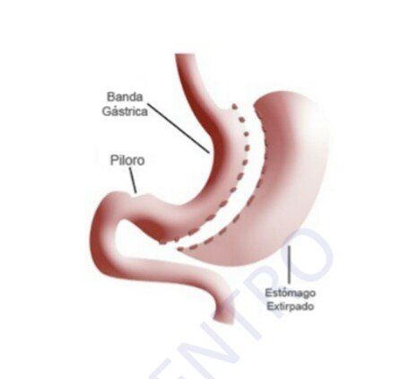 EnfermerosA's tweet image. ⏩Cirugía Bariátrica: Obesidad Mórbida 
➡Y de Roux o bypass gástrico  ➡Gastrectomía Vertical
Técnicas, Preparación del Paciente y Quirófano e Instrumentación 😷
#EnfermerosQuirófanoAlcázar #GuíasQuirúrgicas #AprenderYCompartir @charo_79 @AeeqSpain

▶docs.wixstatic.com/ugd/655e88_994…