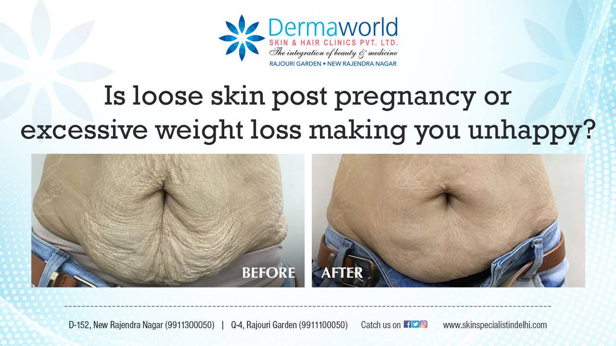 dermaworld on Twitter: "Skin tightening by Viora Reaction. A non-invasive  USFDA approved machine based treatment post excessive weight loss, post  pregnancy, post bariatric surgery. So if your loose skin is making you