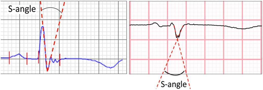 JElectrocardiol's tweet photo. The S-wave angle identifies arrhythmogenic right ventricular cardiomyopathy in patients with electrocardiographically concealed disease phenotype. Read more in the latest issue of #JECG: https://t.co/O4A89kEYsq https://t.co/yEkHvmTMQI
