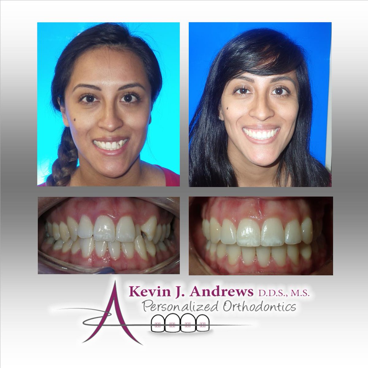 AndrewsBraces's tweet photo. Congratulations Tanya! That new smile is beautiful!! #AndrewsBraces #NewSmile #LoveToSmile #InstaPic #Me #NoFilter #WePutOurHeartIntoYourSmile #Reno https://t.co/GorFWNN001