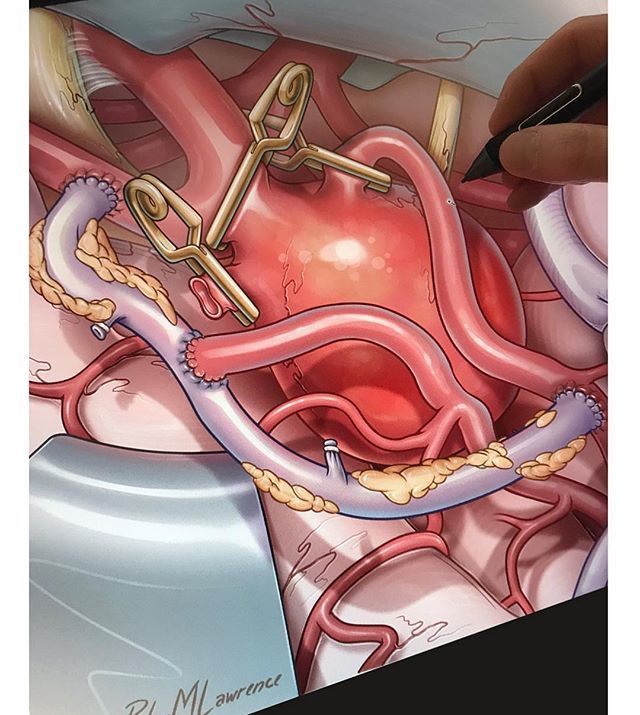technicilly's tweet photo. Repost ✍️ @skuzzz⠀ —⠀ Work in progress #bypass giant #aneurysm
.
.
.
#neuro #surgery #medical #art #medicalillustration #neuroscience #operation #cintiq #photoshop #artwork #drawing #digitalart #artistsoninstagram #illustration #brain #science #wip #… https://t.co/bhcVFd2En5 https://t.co/v18xQVMtCB