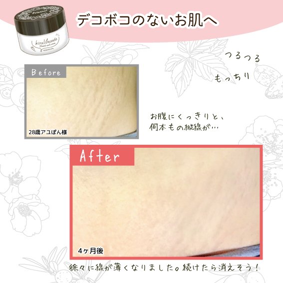 妊娠線が消えた