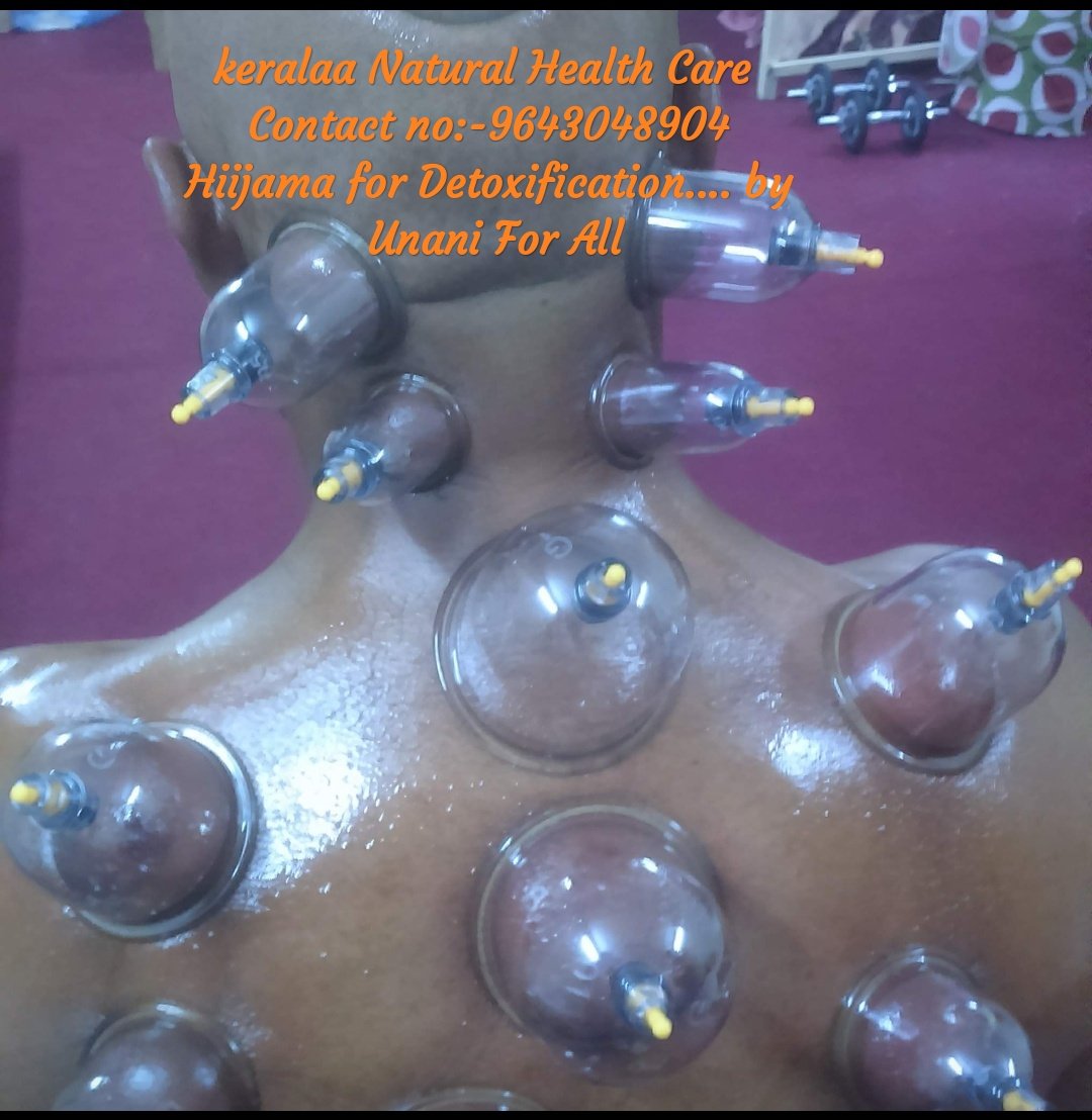 KeralaaC's tweet photo. Hiijama for Detoxification.... by Unani For All https://t.co/p5UhwyrNhq