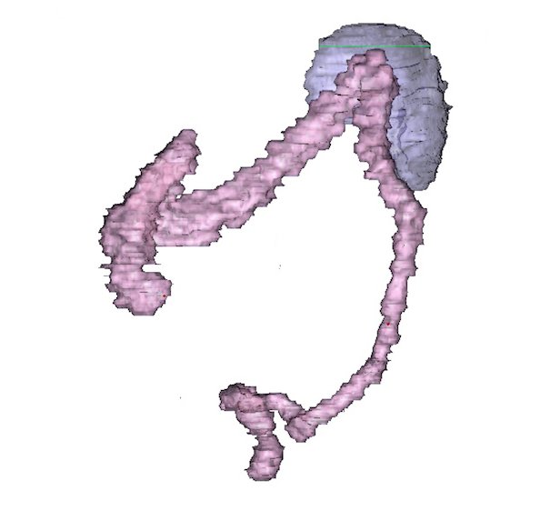 unitomia's tweet photo. Uno de nuestras reconstrucciones 3D más espectaculares del colon normal. Ya en la plataforma https://t.co/DgEzsvMOQJ.
Ahora......a por el holograma de #RealidadAumentada.
#cirugiahrv #ehealth #eSalud #techmedicine #cirugiadelfuturo https://t.co/ATg5ZkT31u