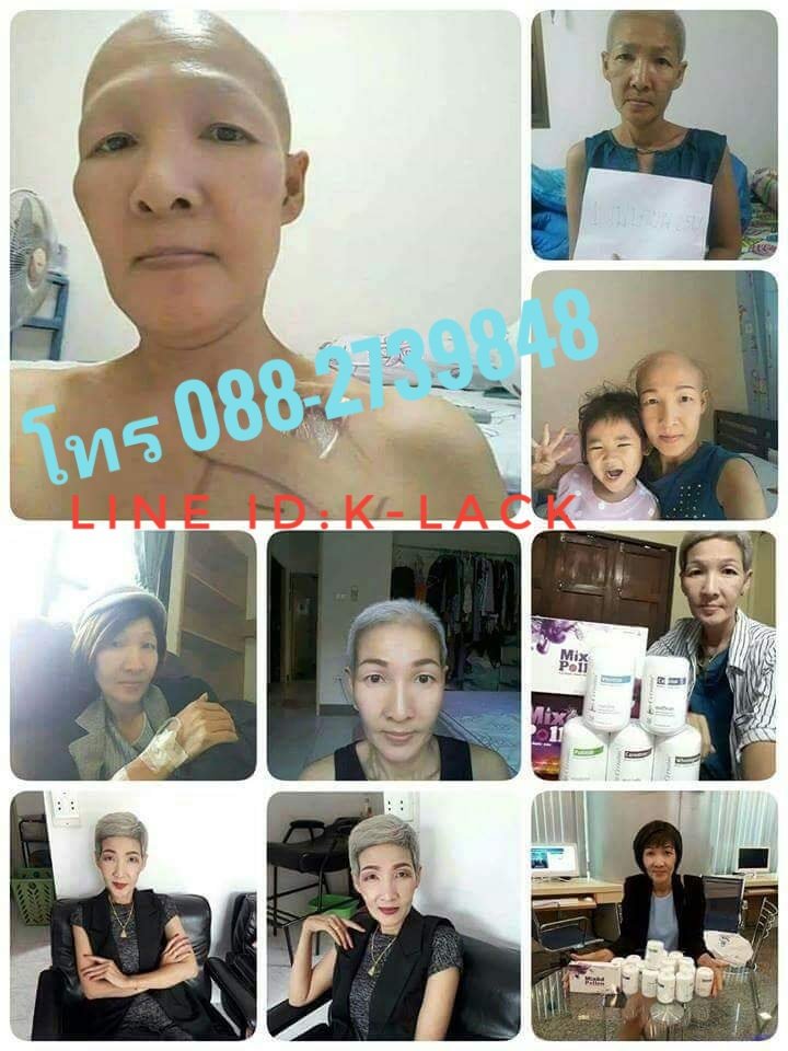 CernitinC's tweet photo. 🚑 โรคร้ายรอดได้ (แพทย์ทางเลือก)
😷มะเร็งเป็นเซลล์ที่ผิดปกติ เป็นเซลล์ที่ได้รับเคมีและสารพิษมากเกินไป ถ้าเรารักษาด้วยการด้วยการให้คีโม หรือ ฉีดสี ฉายแสง นั่นหมายถึงคุณกำลังนำสารพิษเข้าสู่ร่างกายเพิ่มมากขึ้น คนส่วนมากเสียชีวิต เพราะทนรับผลข้างเคียงของคีโมไม่ได้ ยินดีให้คำปรึกษาฟรี https://t.co/WeRfHzpGgj