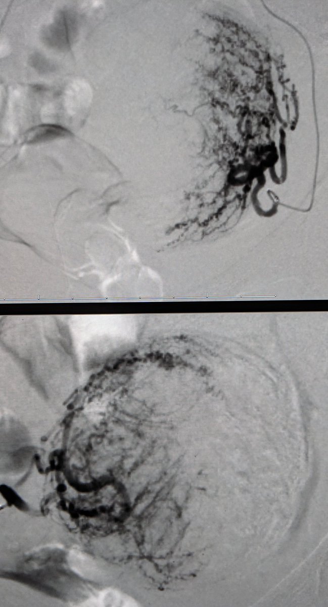 LessneVIR's tweet photo. Woman w menorrhagia-related anemia &amp; menstrual pain w fibroids and extensive adenomyosis. Treated through pin-hole in her artery. Almost 1 yr later, symptom free &amp; smiling in #IRad clinic. #UAE works! #KeepYourU @CLTRadiology @oprahmagazine @acog @SIRspecialists https://t.co/HP50QDyBXU