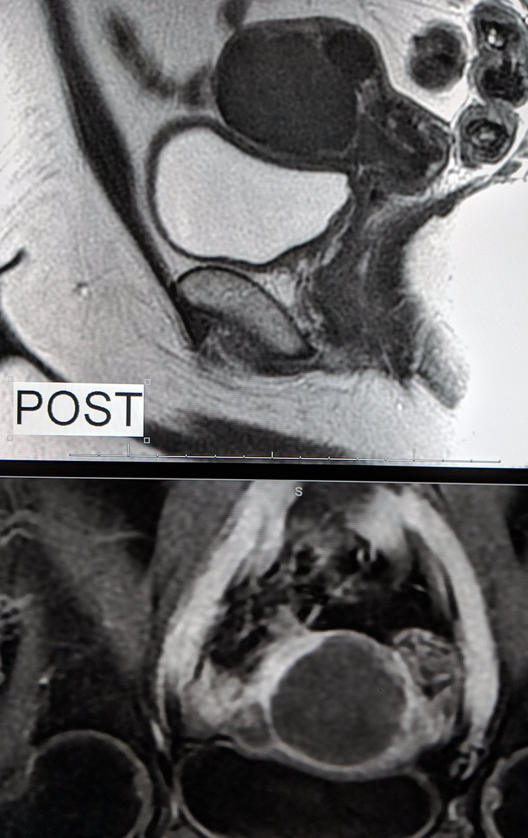 LessneVIR's tweet photo. Woman w menorrhagia-related anemia &amp; menstrual pain w fibroids and extensive adenomyosis. Treated through pin-hole in her artery. Almost 1 yr later, symptom free &amp; smiling in #IRad clinic. #UAE works! #KeepYourU @CLTRadiology @oprahmagazine @acog @SIRspecialists https://t.co/HP50QDyBXU